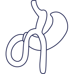 تكميم مع تحويل المسار المصغر